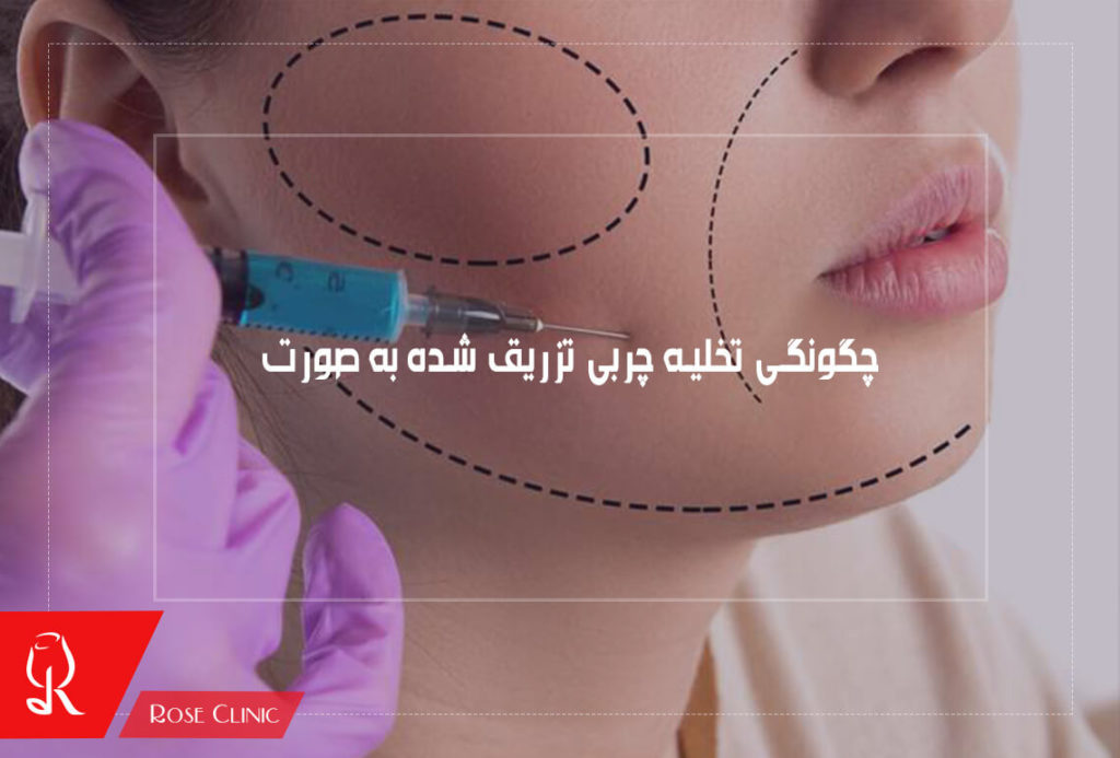 چگونگی تخلیه چربی تزریق شده به صورت