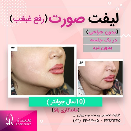 عکس لیفت صورت