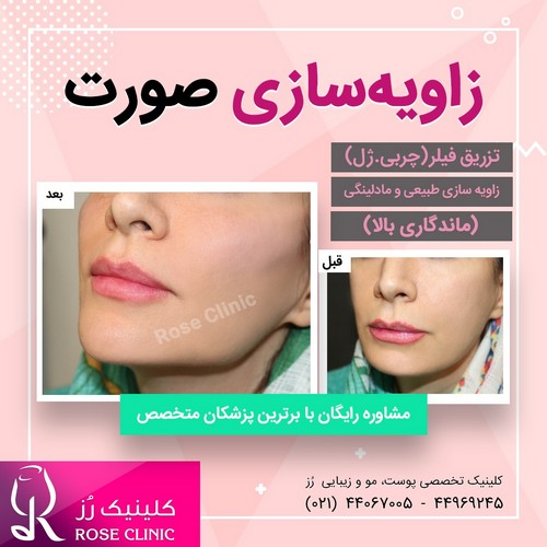 عکس تزریق ژل