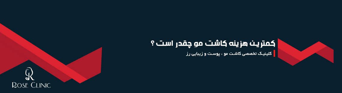 کمترین هزینه کاشت مو چقدر است ؟