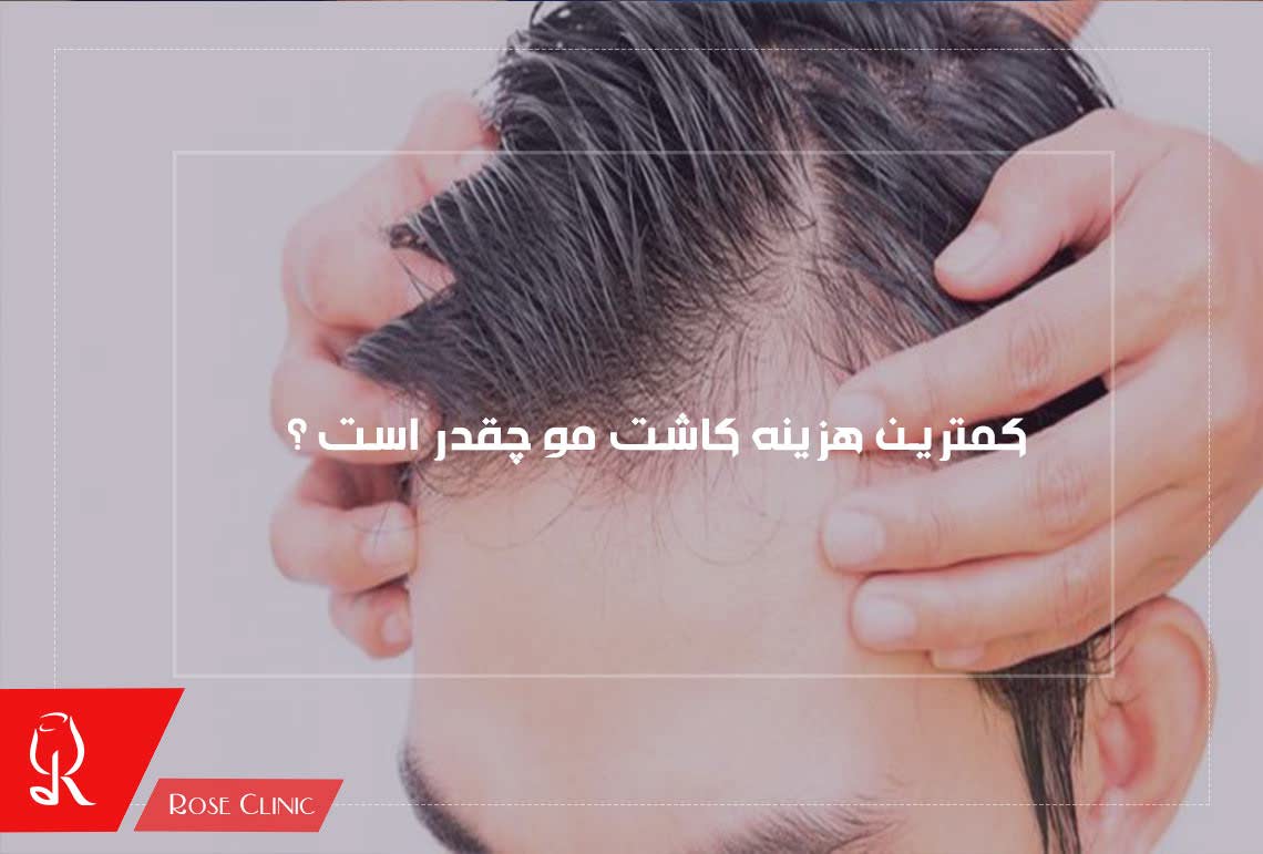 کمترین هزینه کاشت مو چقدر است ؟