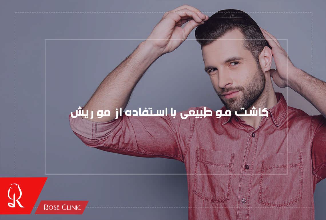 کاشت مو طبیعی با استفاده از مو ریش