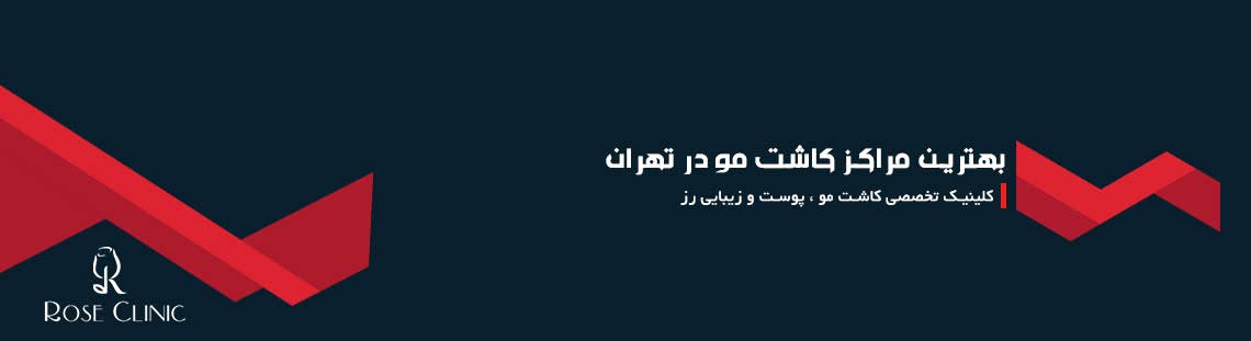 بهترین مراکز کاشت مو در تهران