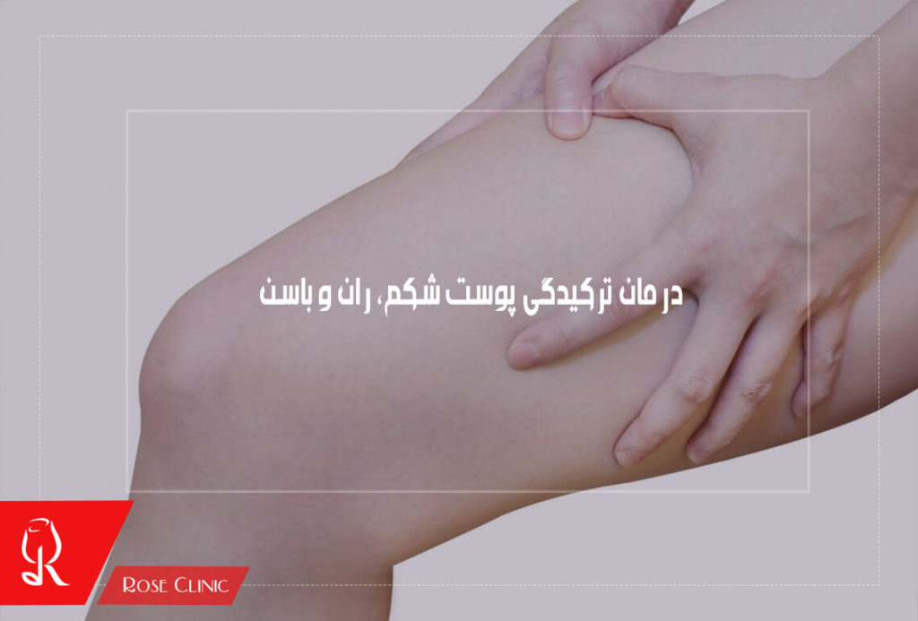 درمان ترکیدگی پوست شکم و ران و باسن