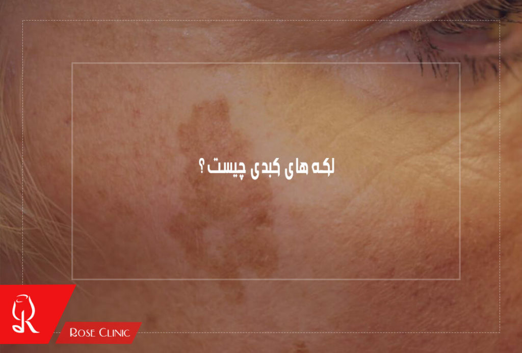 لکه های کبدی چیست ؟