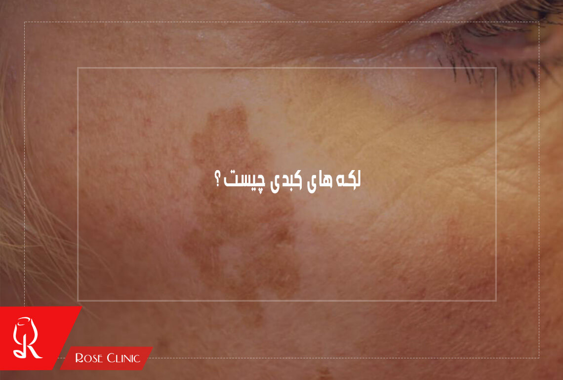 لکه های کبدی چیست ؟