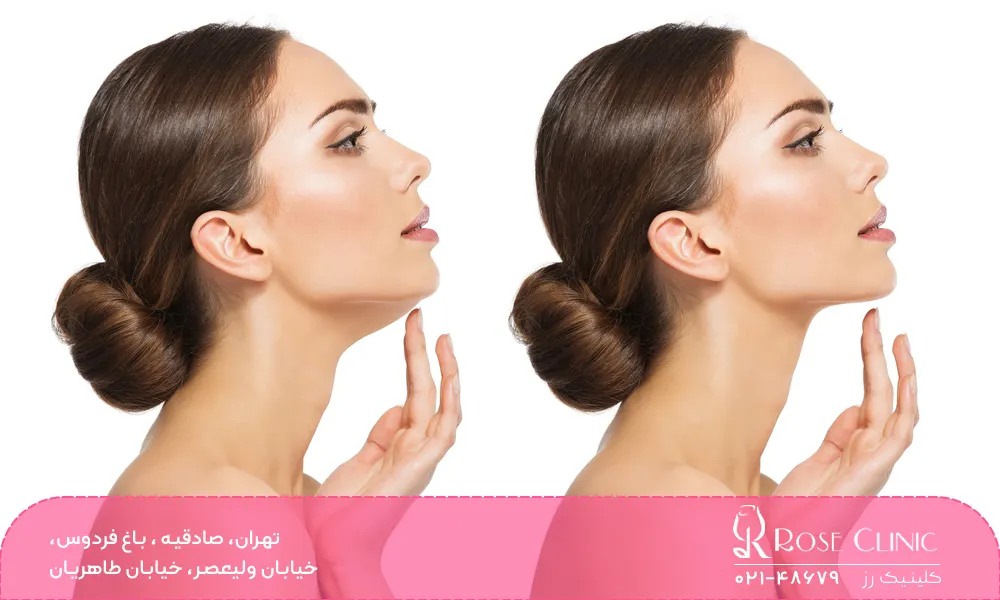 فرآیند انجام کانتورینگ