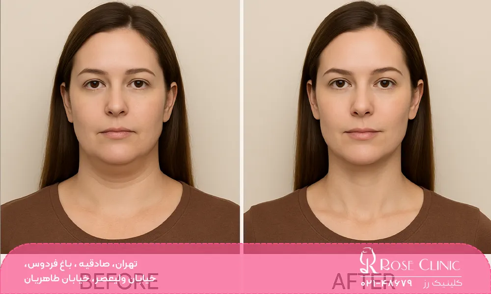 مدت زمان، بهبودی و ماندگاری نتایج کانتورینگ