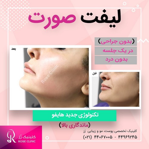 عکس لیفت صورت 
