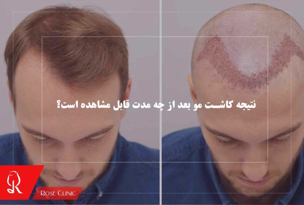 نتیجه کاشت مو بعد از چه مدت قابل مشاهده است؟