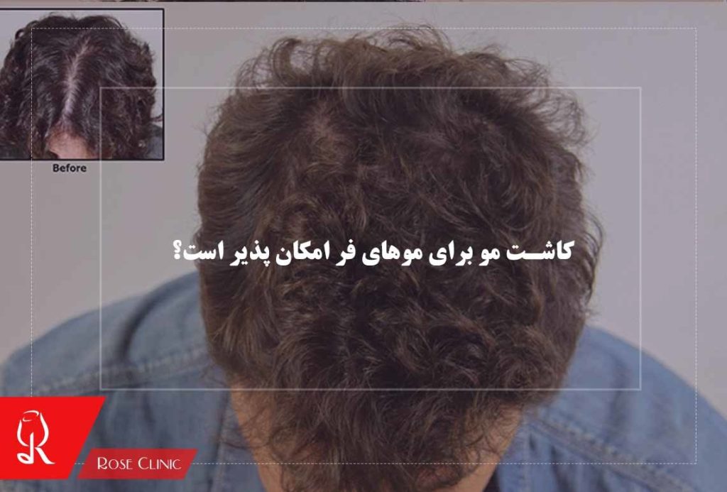 کاشت مو برای موهای فر امکان پذیر است؟