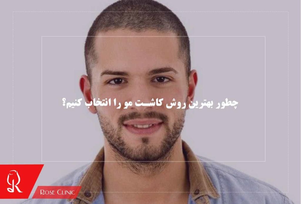 چطور بهترین روش کاشت مو را انتخاب کنیم؟