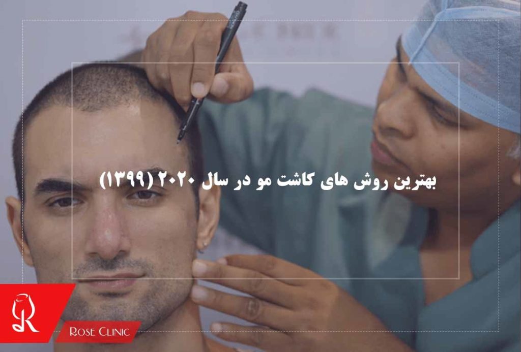 بهترین روش های کاشت مو در سال 2020 (1399)