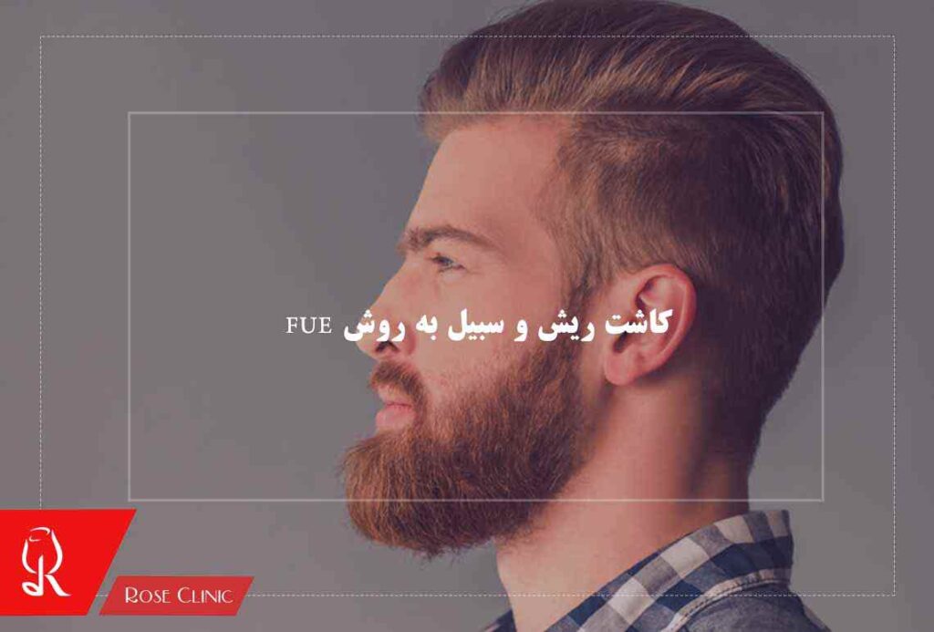 کاشت ریش و سبیل به روش FUE