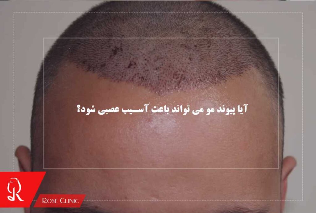 آیا پیوند مو می تواند باعث آسیب عصبی شود؟