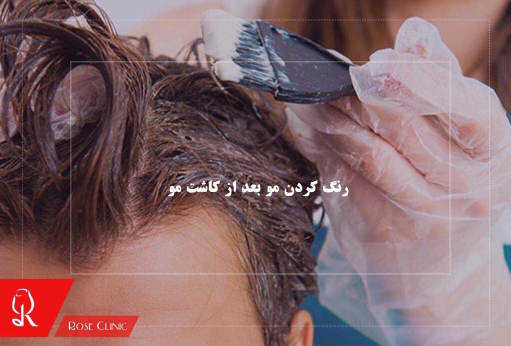 رنگ کردن مو بعد از کاشت مو