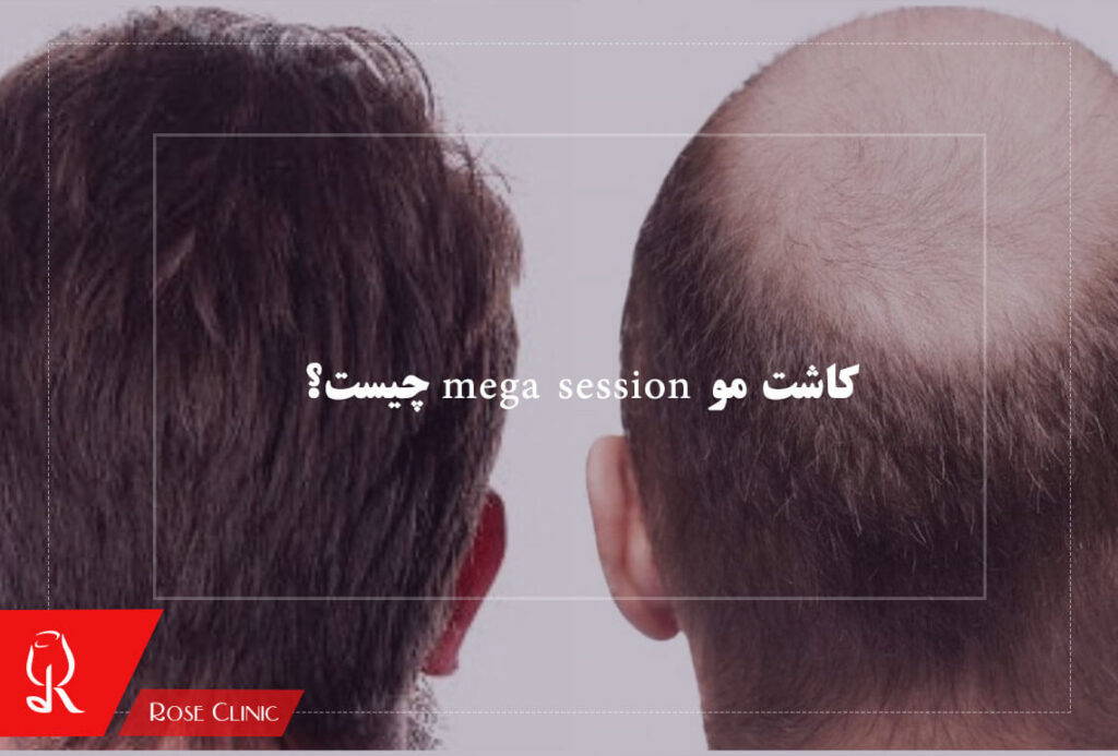 کاشت مو mega session چیست؟