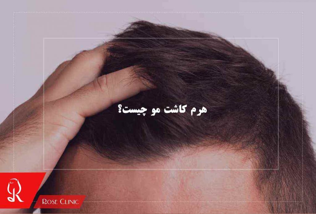 هرم کاشت مو چیست؟