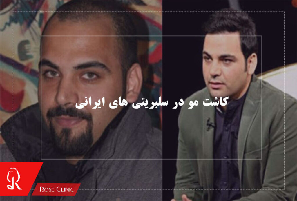 کاشت مو در سلبریتی های ایرانی