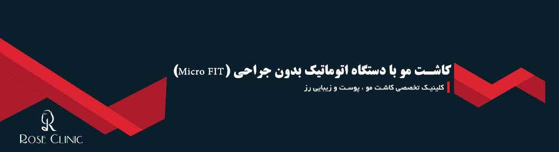 کاشت مو با دستگاه اتوماتیک بدون جراحی (Micro FIT)