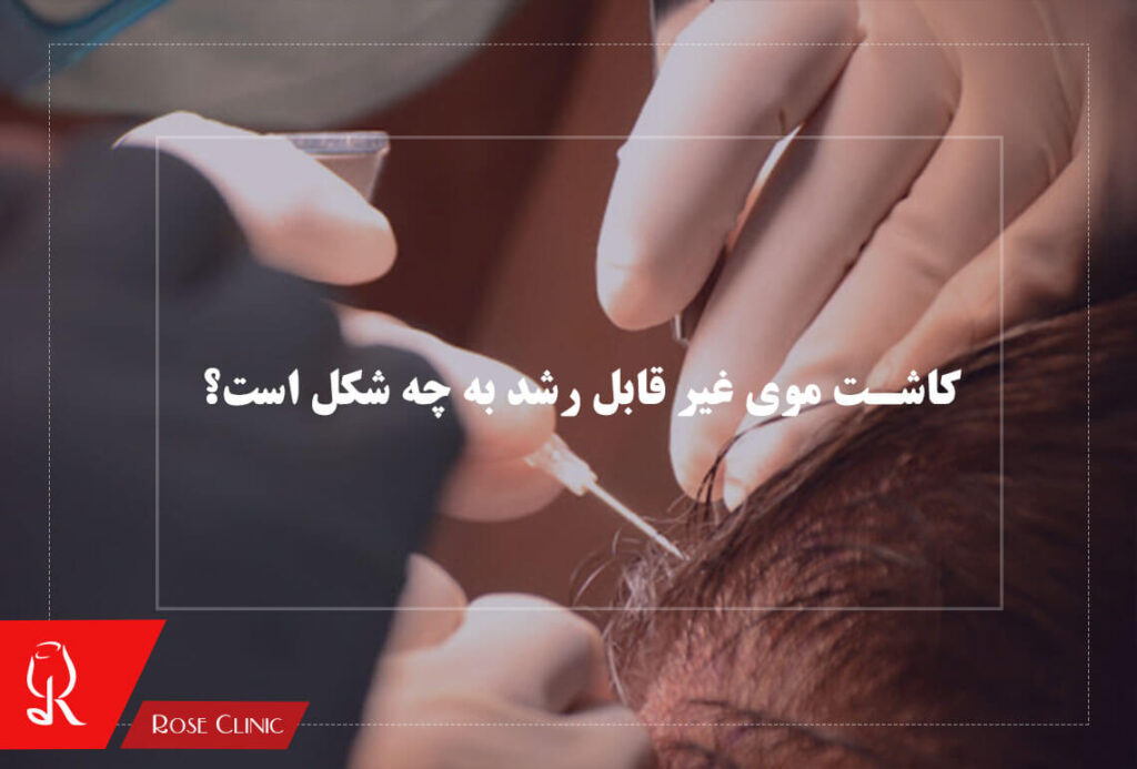 کاشت موی غیر قابل رشد به چه شکل است؟