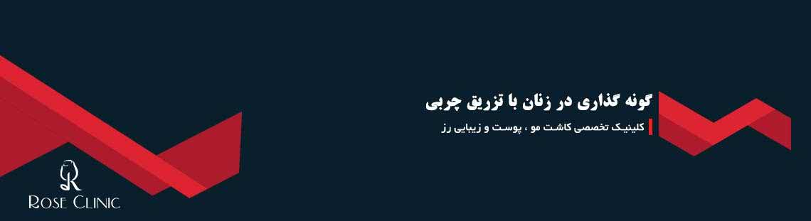 گونه گذاری در زنان با تزریق چربی