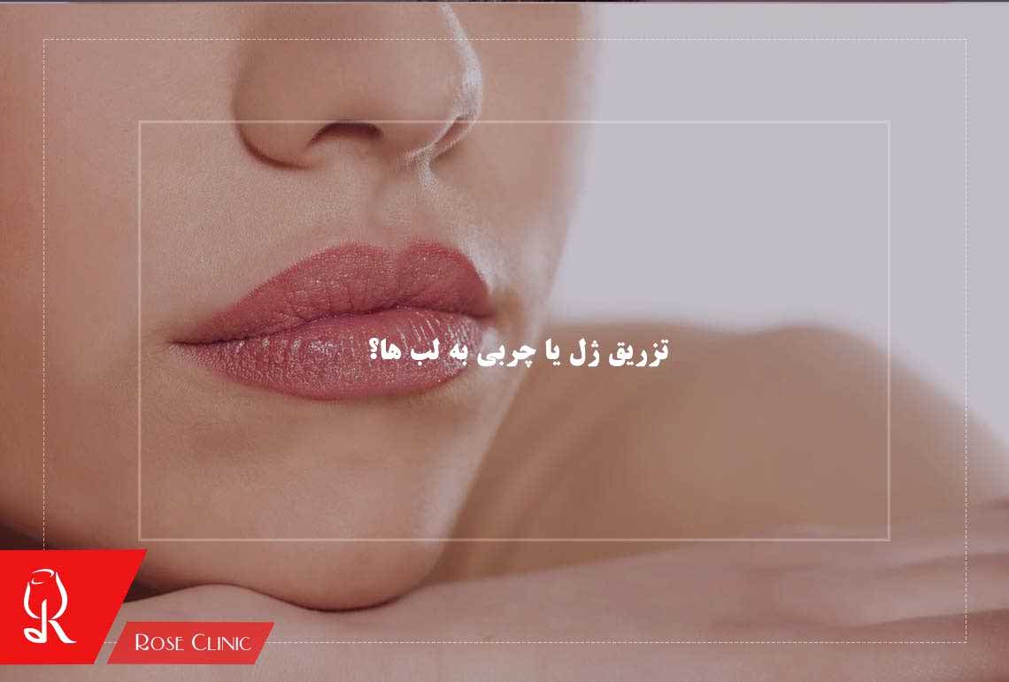 تزریق ژل یا چربی به لب ها؟