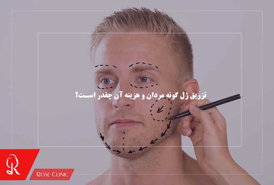 تزریق ژل گونه مردان