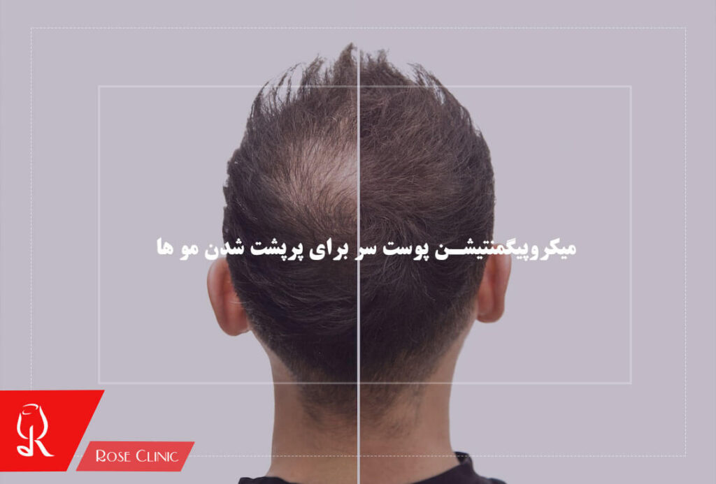 میکروپیگمنتیشن پوست سر برای پرپشت شدن مو ها