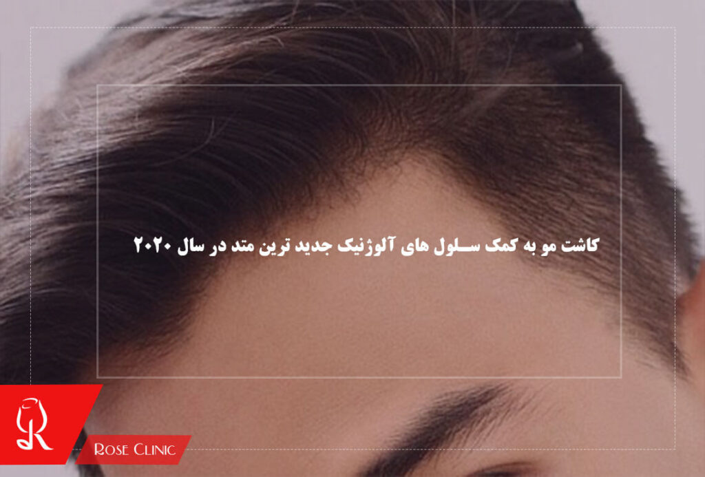 کاشت مو به کمک سلول های آلوژنیک جدید ترین متد در سال 2020