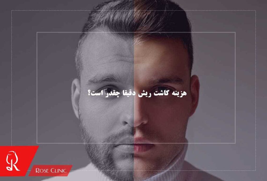 هزینه کاشت ریش