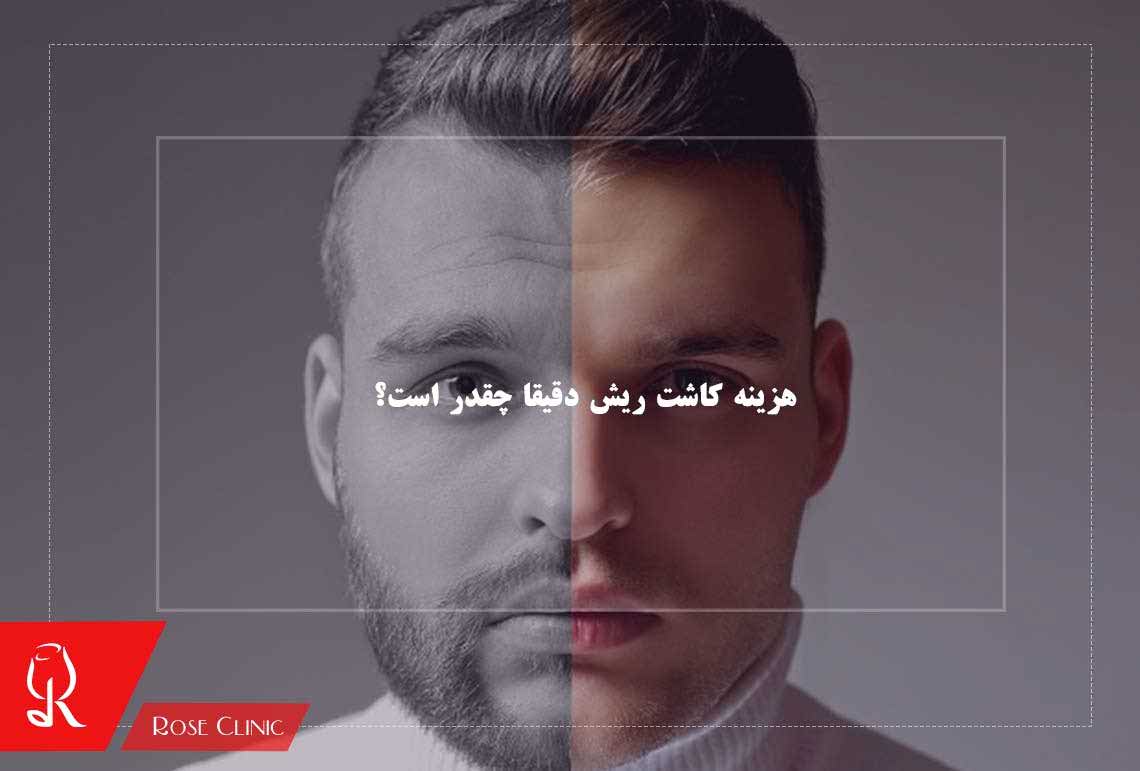 هزینه کاشت ریش