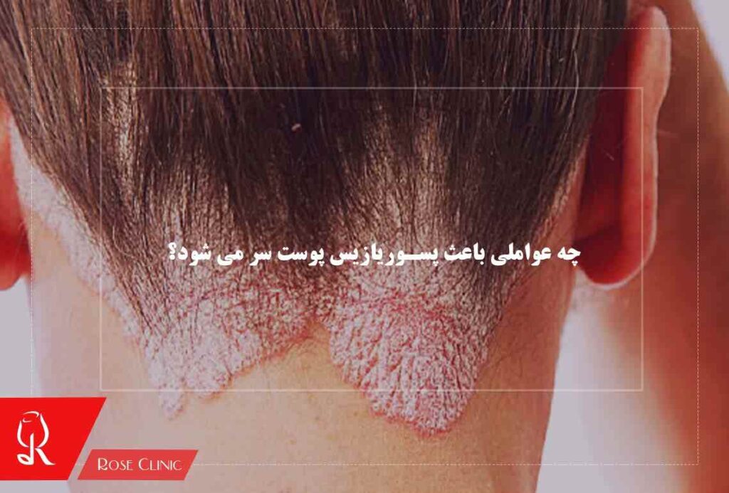 چه عواملی باعث پسوریازیس پوست سر می شود؟