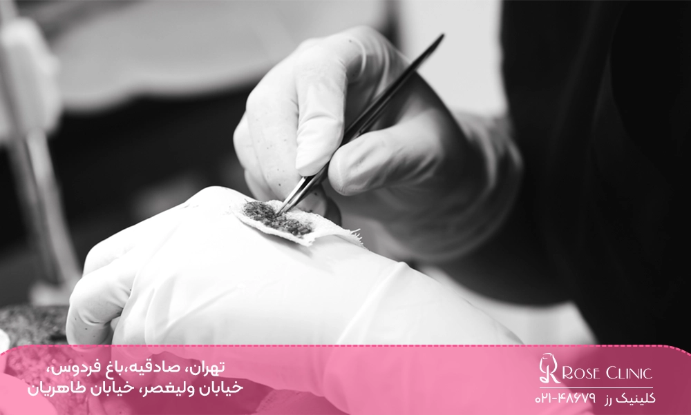 آماده کردن گرافت های مو برای کاشت در بهترین کلینیک کاشت مو در تهران