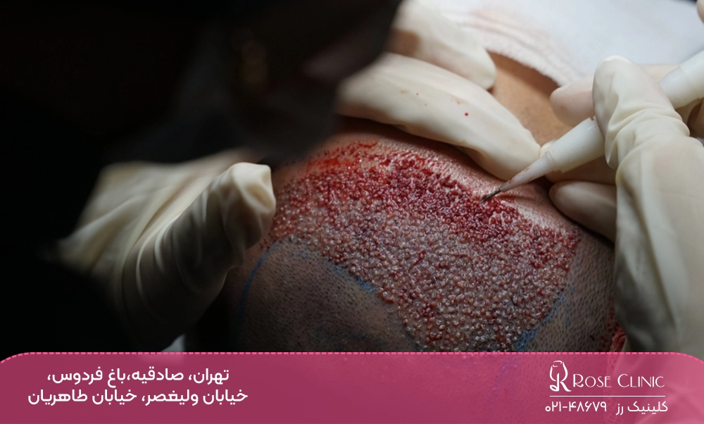 بهترین کلینیک کاشت مو در تهران برای مردان و زنان