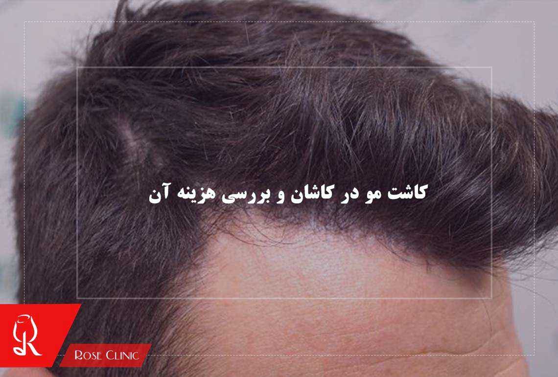 کاشت مو در کاشان و بررسی هزینه آن 