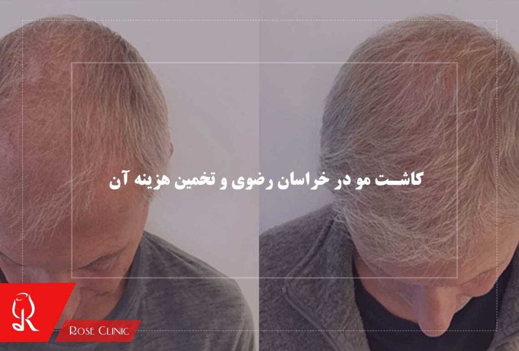 کاشت مو در خراسان رضوی و تخمین هزینه آن