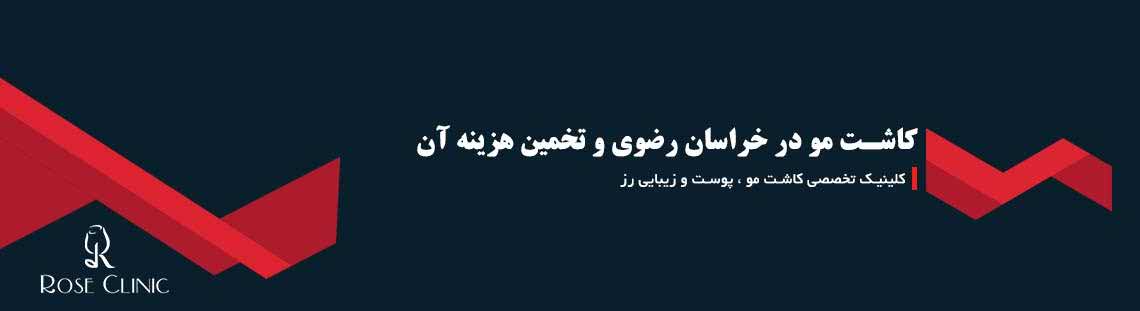 کاشت مو در خراسان رضوی و تخمین هزینه آن