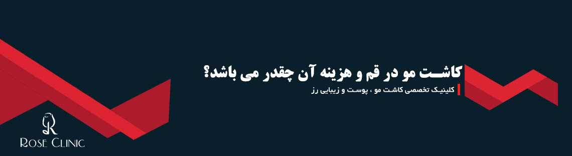 کاشت مو در قم و هزینه آن چقدر می باشد؟