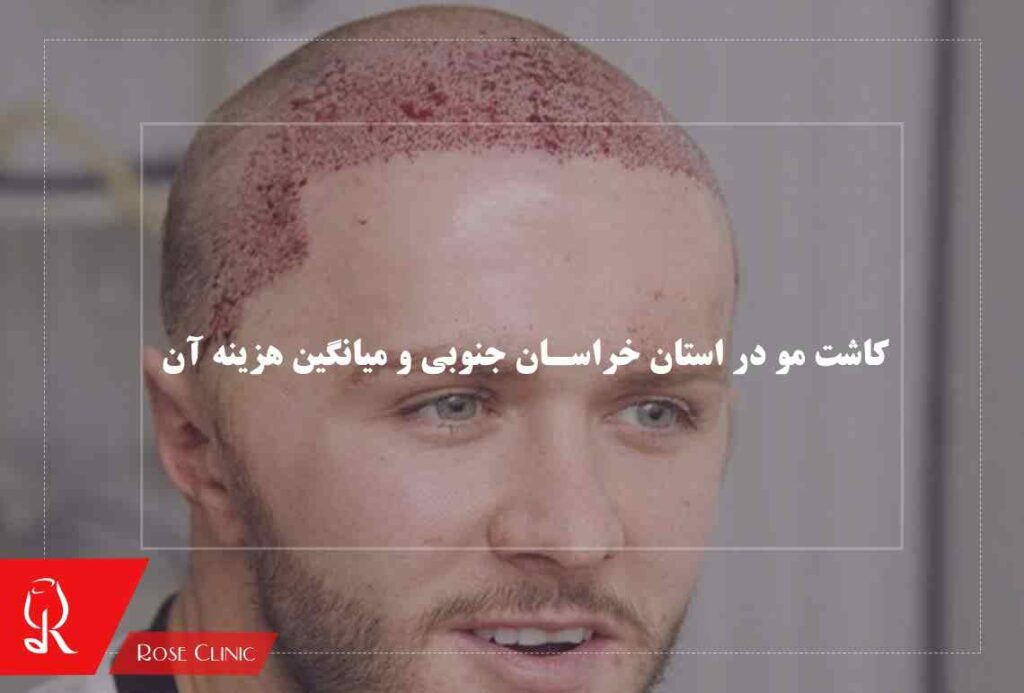 کاشت مو در استان خراسان جنوبی و میانگین هزینه آن