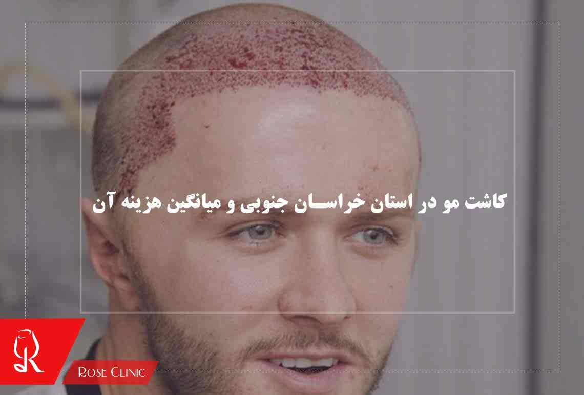 کاشت مو در استان خراسان جنوبی و میانگین هزینه آن