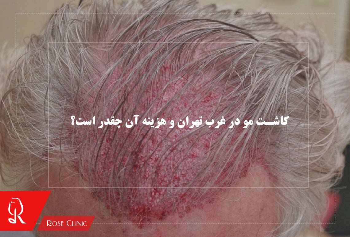 کاشت مو در غرب تهران و هزینه آن چقدر است؟