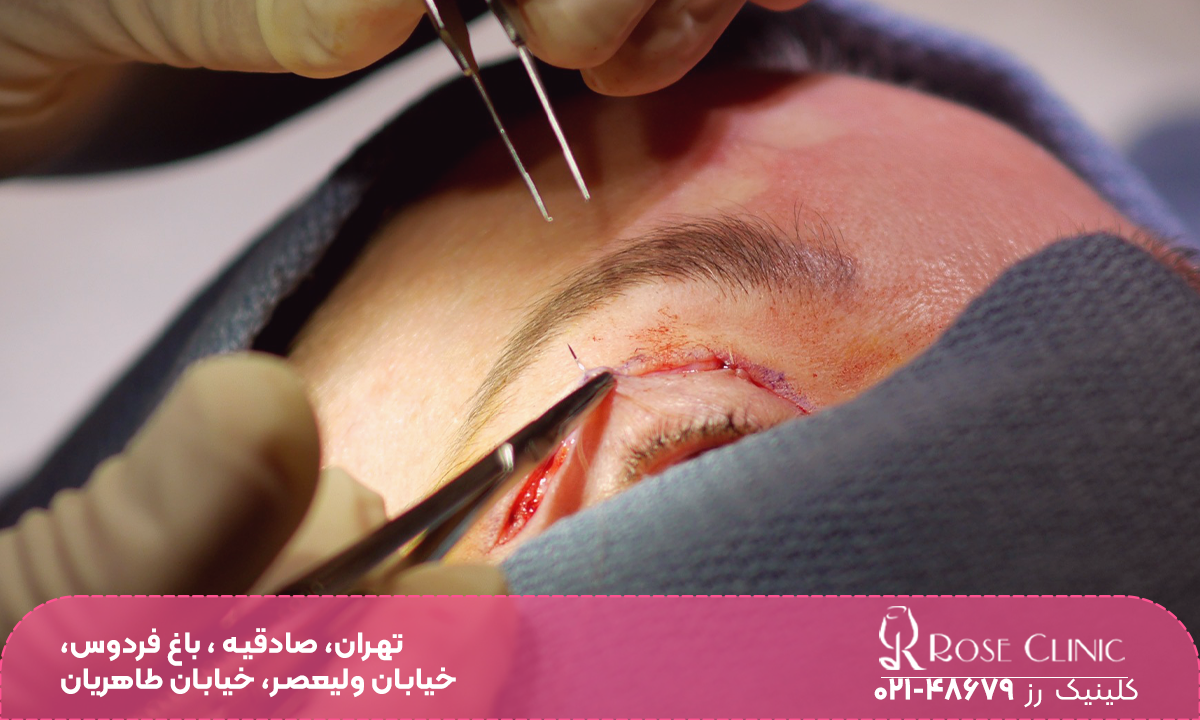 فردی که بیهوش است و دست دکتر که در حال جراحی بلفاروپلاستی چشم گربه ای است