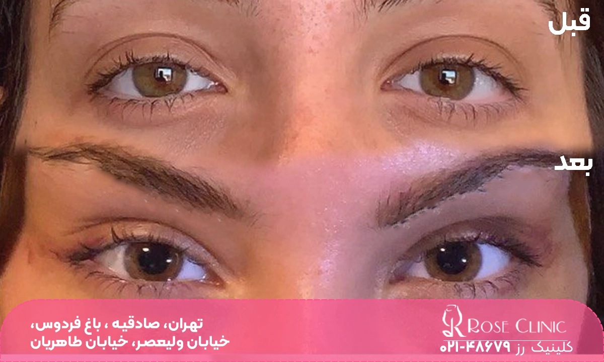 عکس قبل و بعد فردی که عمل بلفارو پلاستی چشم گربه ای انجام داده است