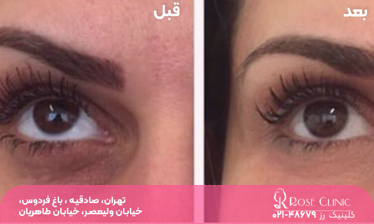 عکس قبل و بعد چشم دختری که با تزریق مزوژل تیرگی و گودی زیر چشم او رفع شده است