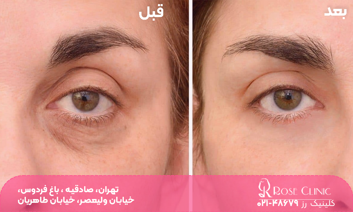 عکس قبل و بعد تزریق مزوژل زیر چشم دختر که فرورفتگی زیر چشم او برطرف شده است