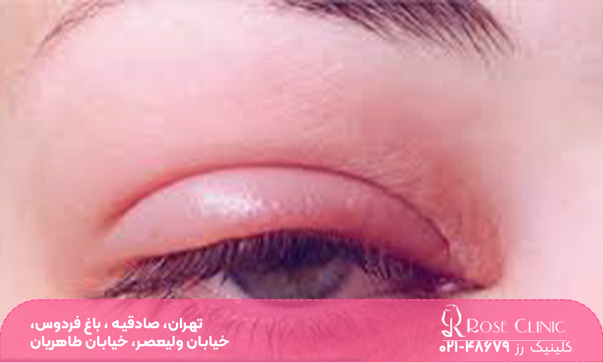 پلک بالای چشم فردی که بعد قرمز و ملتهب شده است - بخیه بلفاروپلاستی