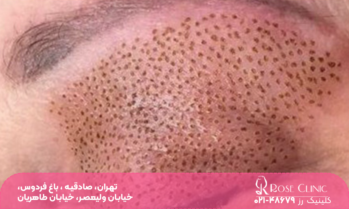 جای لیزر روی پوست فردی که برای رفع جای بخیه از دستگاه لیزر استفاده کرده است