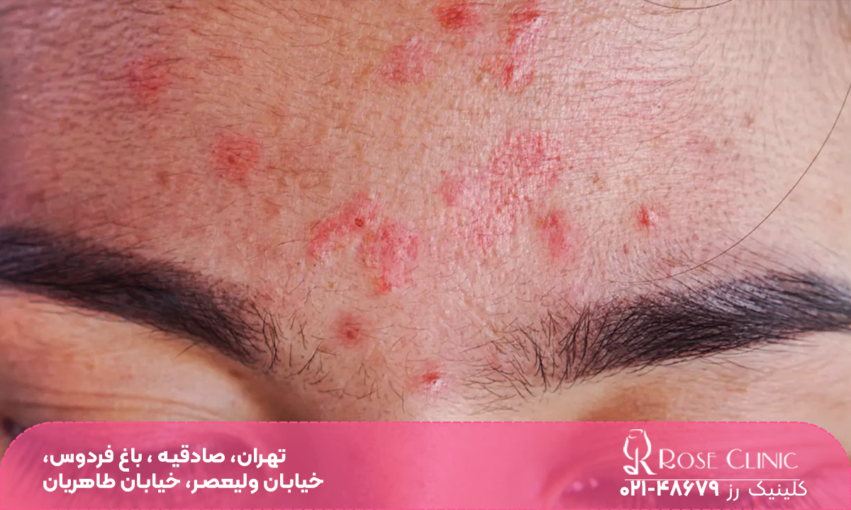 فردی که روی پیشانی اش و بین ابروهای او جوش های زیادی زده است