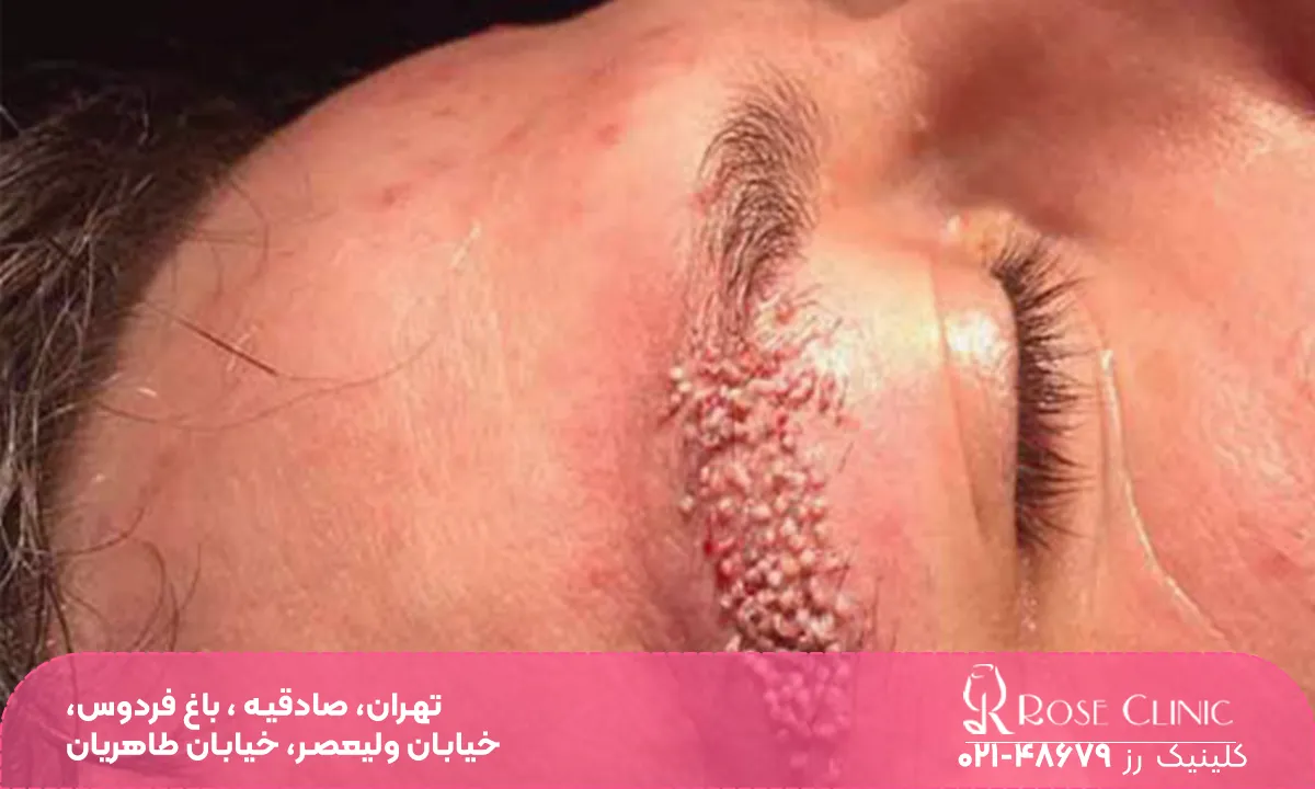 عکس نزدیک از ابروی فردی که کاشت انجام داده و ناحیه کاشت دلمه زده است